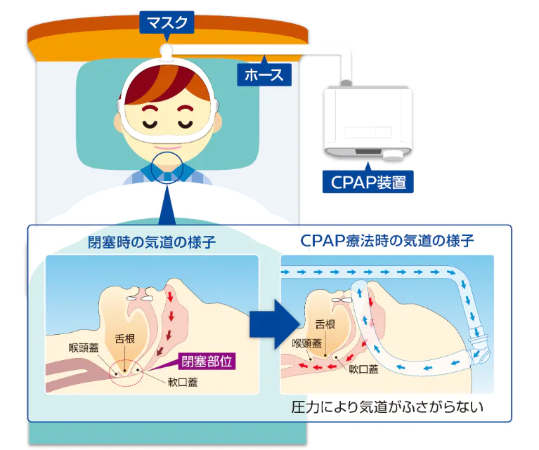 CPAP療法